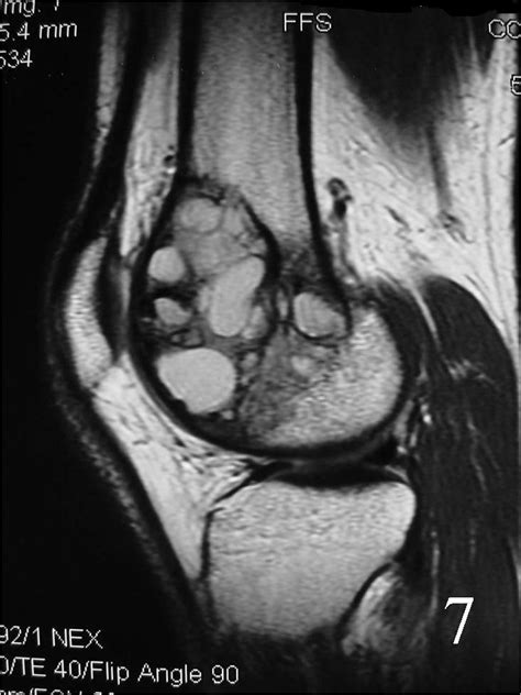 Giant Cell Tumor Mri