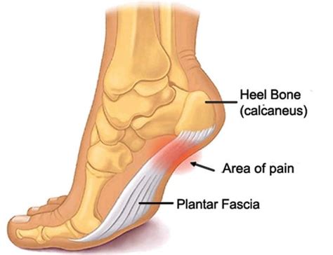 Plantar Fasciitis: Causes, Symptoms, Treatments + Best Shoes