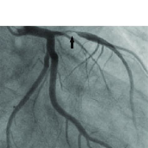 Coronary angiogram shows the LAD lesion (arrow). LAD = left anterior... | Download Scientific ...