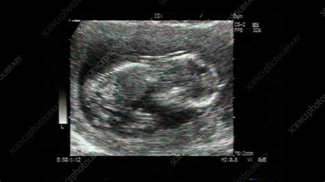 Twins, ultrasound scan - Stock Video Clip - K001/2917 - Science Photo ...