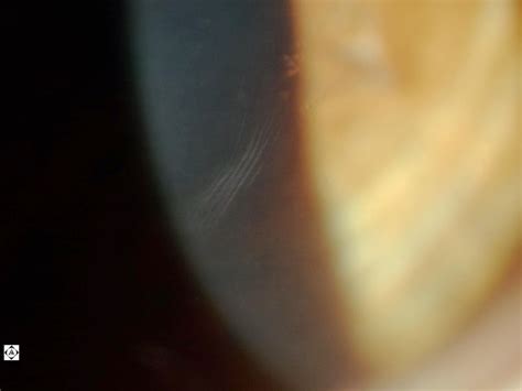 VOGT'S STRIA IN KERATOCONUS | Sonoran Desert Eye Center