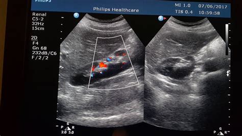 Malrotated Kidney Sonography - YouTube