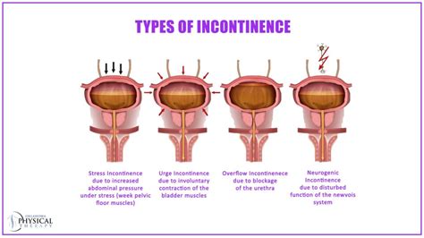 Can Incontinence Go Away at Alexandra Lui blog