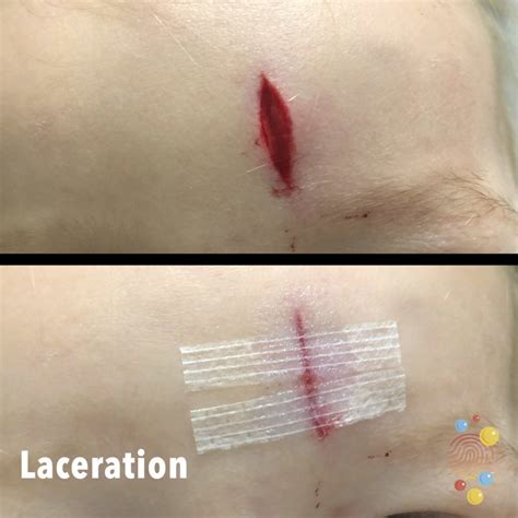 Types Of Lacerations at Wilma Lewis blog