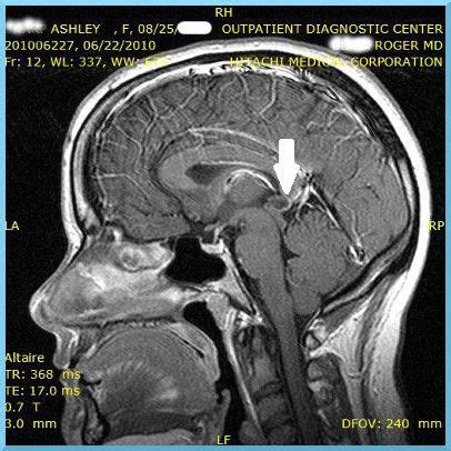 Discovering the Pineal Gland: Understanding Pineal Cysts