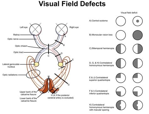 Hemianopia: Everything You Need To Know About Hemianopia [Types, Diagnosis & Treatment] - Daily ...