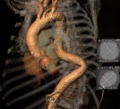 Thoracic Aorta Perforation Treated Conservatively After TAVR in a ...