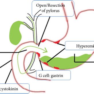 Pathogenesis of bile reflux gastritis. Reflux—gastroduodenal... | Download Scientific Diagram