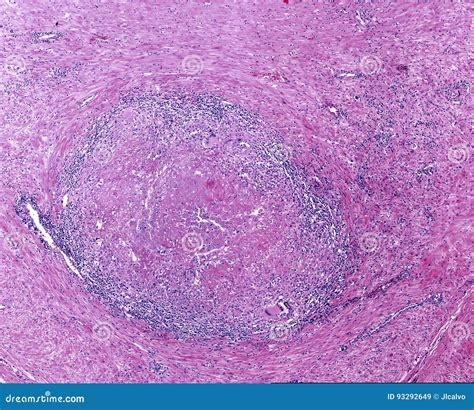 Tuberculosis Granuloma. Langhans Cell Stock Image - Image of ...