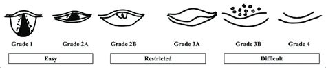 Modified Cormack-Lehane grading for laryngeal view. Grade 1-most of the... | Download Scientific ...