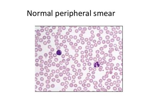 Normal Peripheral Blood Smear