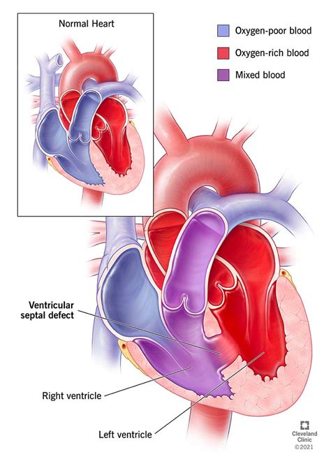 Ventricular Septal Defect (VSD): What Is It, Types, Causes & Symptoms