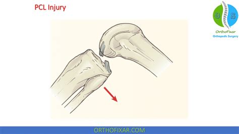 Posterior Drawer Test Of The Knee | OrthoFixar 2024