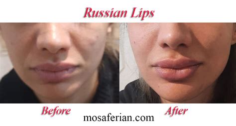 russian lip filler