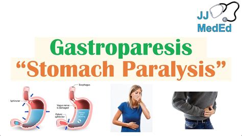 Gastroparesis (Stomach Paralysis) | Causes and Risk Factors, Signs & Symptoms, Diagnosis ...