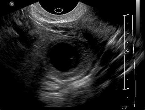 Corpus luteum | Image | Radiopaedia.org