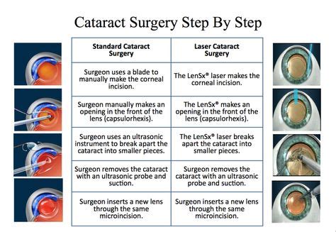 About Cataract Surgery | Cataract