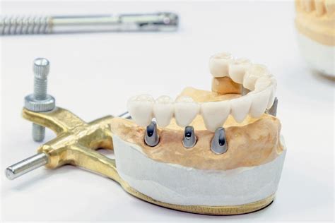 Dental Implants Near Me - Dental Park