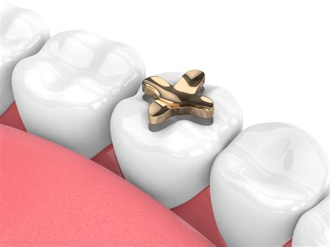 Difference Between Inlay and Onlay in Dentistry - William Fitzgerald