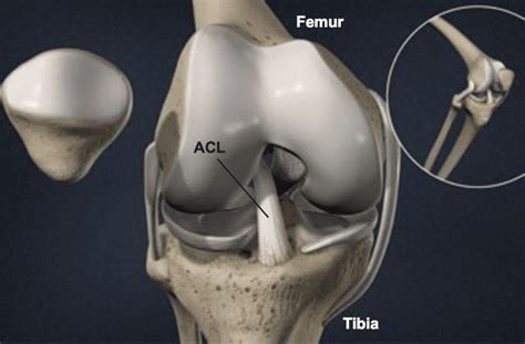 Anterior Cruciate Ligament (ACL) Tear - Florida Surgery Consultants