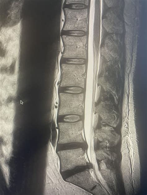 MRI Interpretation : r/Sciatica