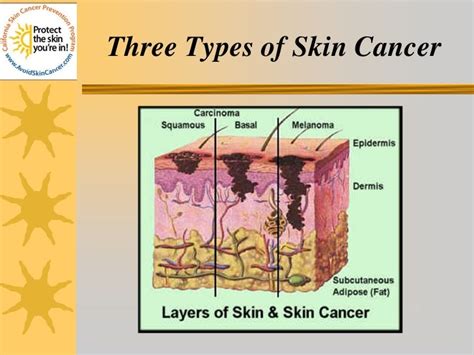 Skin Cancer Prevention