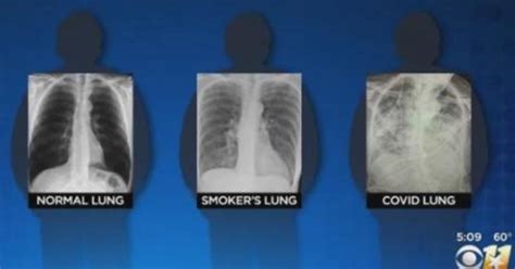 Post-COVID lungs worse than the worst smokers' lungs, surgeon says ...