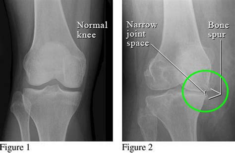 Bone Spur - Osteophytes, Causes, Signs, Symptoms & Treatment