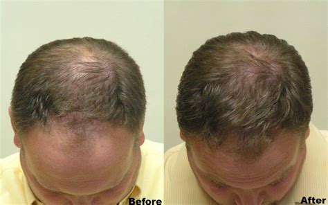 Laser Hair Cap｜LLLT Laser Cap for Hair Growth - ReHair Laser