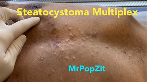 Steatocystoma Multiplex. Dozens of extractions on the chest. Chronic condition. MrPopZit. - YouTube