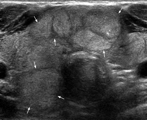 Thyroid Goiter Ultrasound