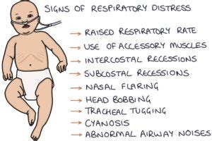 Bronchiolitis – Zero To Finals