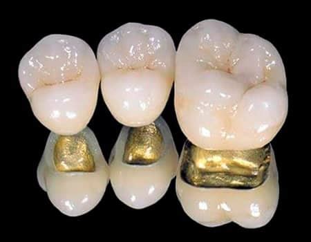 PFM Crown - Full List Of Prices Dental Crowns Mexico - Price Guide 2024