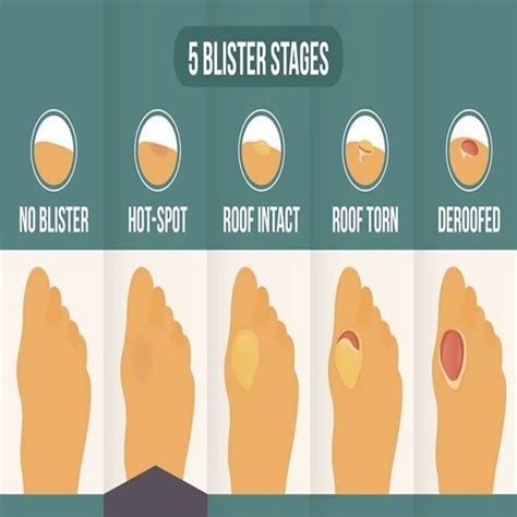 Blister Hot Spot | Hot Spot On Foot: A Pre-Blister State