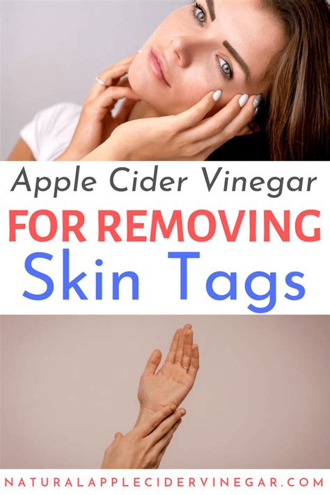 How to Use Apple Cider Vinegar to Remove Skin Tags | Skin tag removal, Skin tag, Apple cider ...