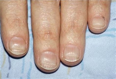 What Are Beau's Lines? - Health - NAILS Magazine