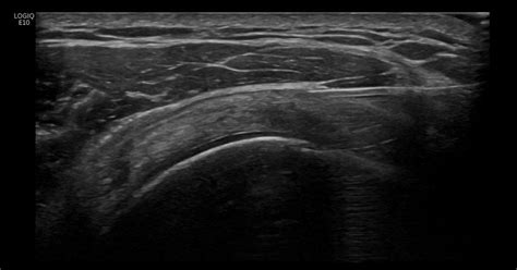 Subacromial Subdeltoid Bursa Transverse Approach Ultrasound Guided | SexiezPicz Web Porn