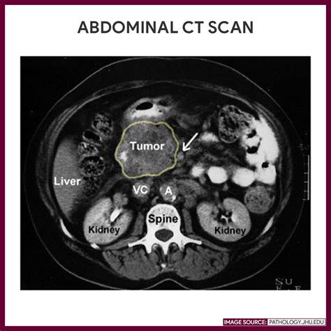 Computed Tomography (CT) Scan - Nursing Responsibilities - Nurseslabs