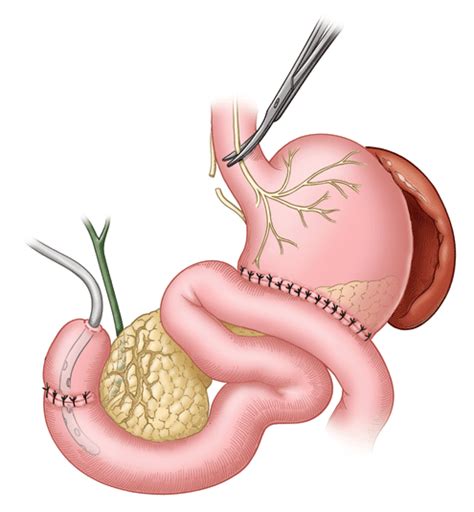 Duodenostomy