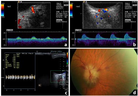 Ultrasound and funduscopic findings in patients with central retinal... | Download Scientific ...