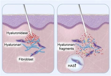 Dissolve Filler (Hyalase) Injection - Dr Peter Kim Surgery - Skin ...