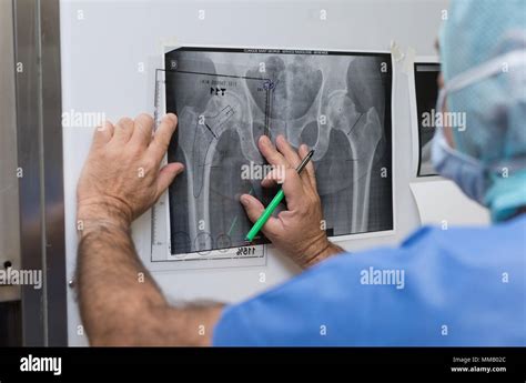 HIP PROSTHESIS, SURGERY Stock Photo - Alamy