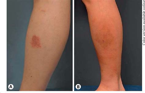 Treatment of Pigmented Purpuric Dermatosis with Topical Photodynamic Therapy | Semantic Scholar