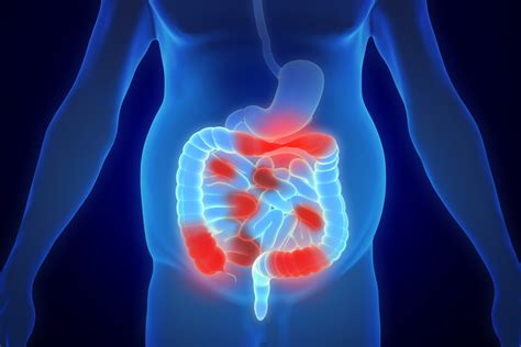 Crohn’s Disease - Kingwood GI - Gastroenterology Clinic