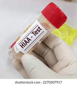 Urine Sample 5hydroxyindoleacetic Acid 5hiaa Test Stock Photo 2270307917 | Shutterstock