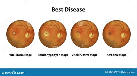 Best Vitelliform Macular Dystrophy Stages, Scientific Illustration ...