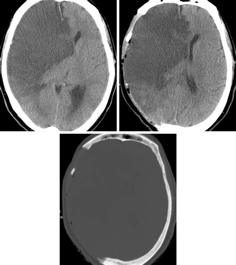 Decompressive Craniectomy | The Neurosurgical Atlas, by Aaron Cohen-Gadol, M.D.