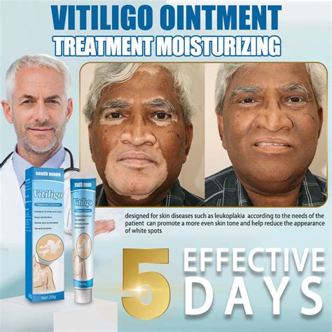 vitiligo treatment cream vitiligo remover skin treatment cream Ointment ...