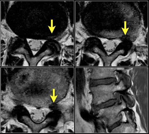 The Radiology Assistant : Lumbar Disc Herniation