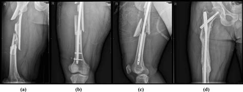 a A comminuted femoral shaft fracture with displaced major fragments. b... | Download Scientific ...